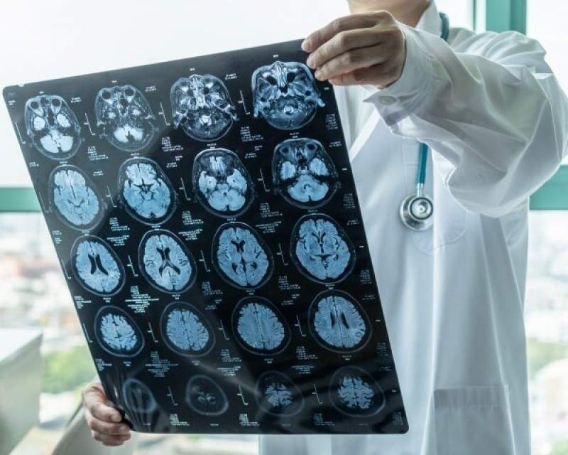 تأیید FDA برای عامل رادیواکتیو Tauklarify در تشخیص آلزایمر