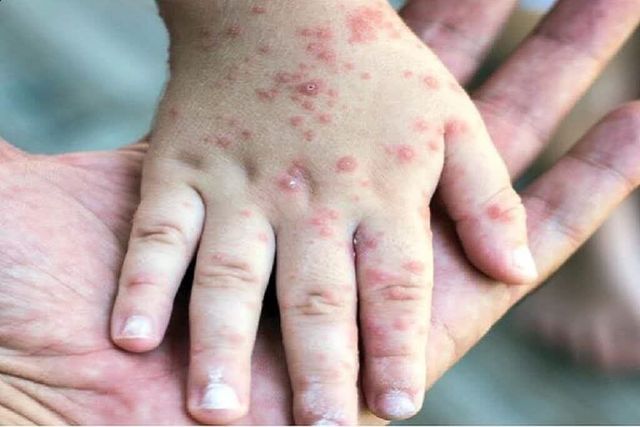 سرخک؛ یکی از مسری‌ترین بیماری‌ها و راه پیشگیری از آن